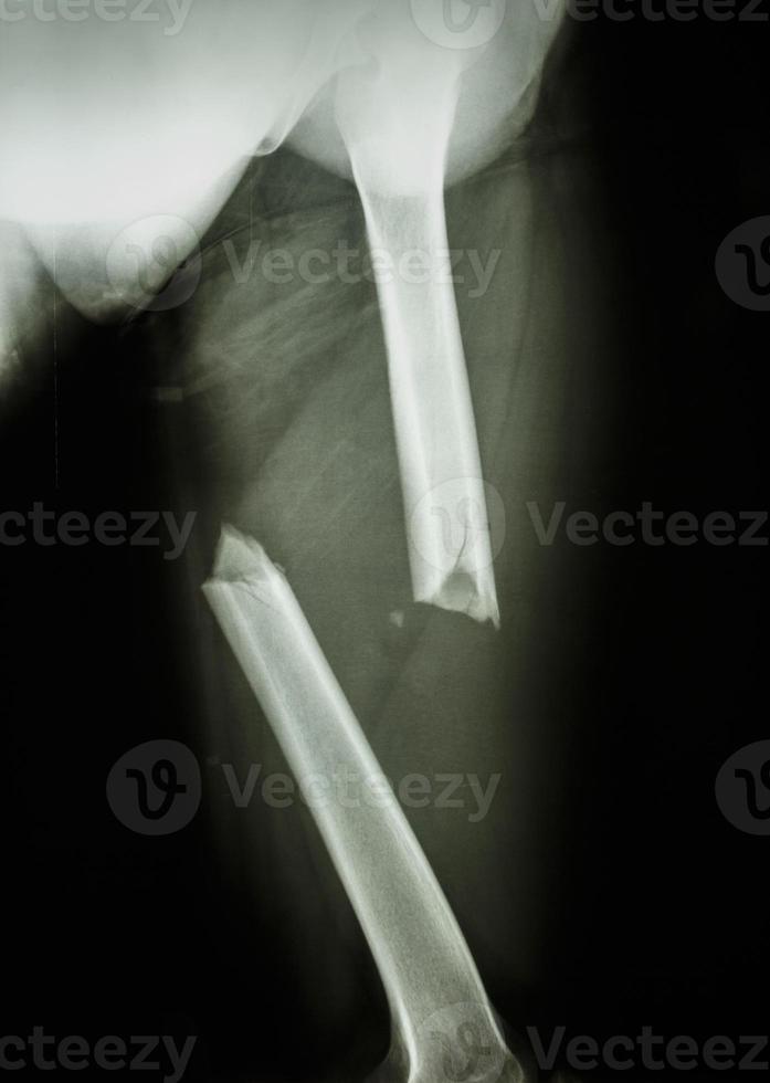 Film X ray Left femur  left thigh  show complete fracture shaft of femur and displace photo