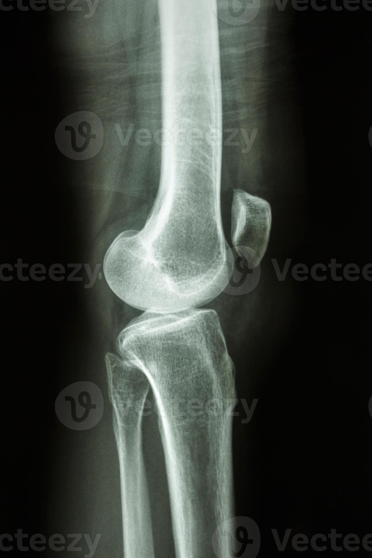 Film X ray knee lateral view show normal human s knee joint 2591219