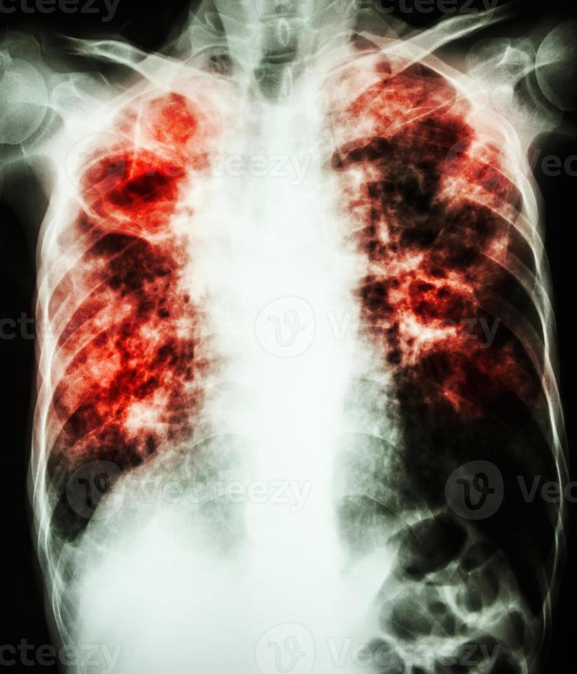 film chest x ray show cavity at right lung fibrosis and interstitial and patchy infiltrate at both lung due to Mycobacterium tuberculosis infection  Pulmonary Tuberculosis photo