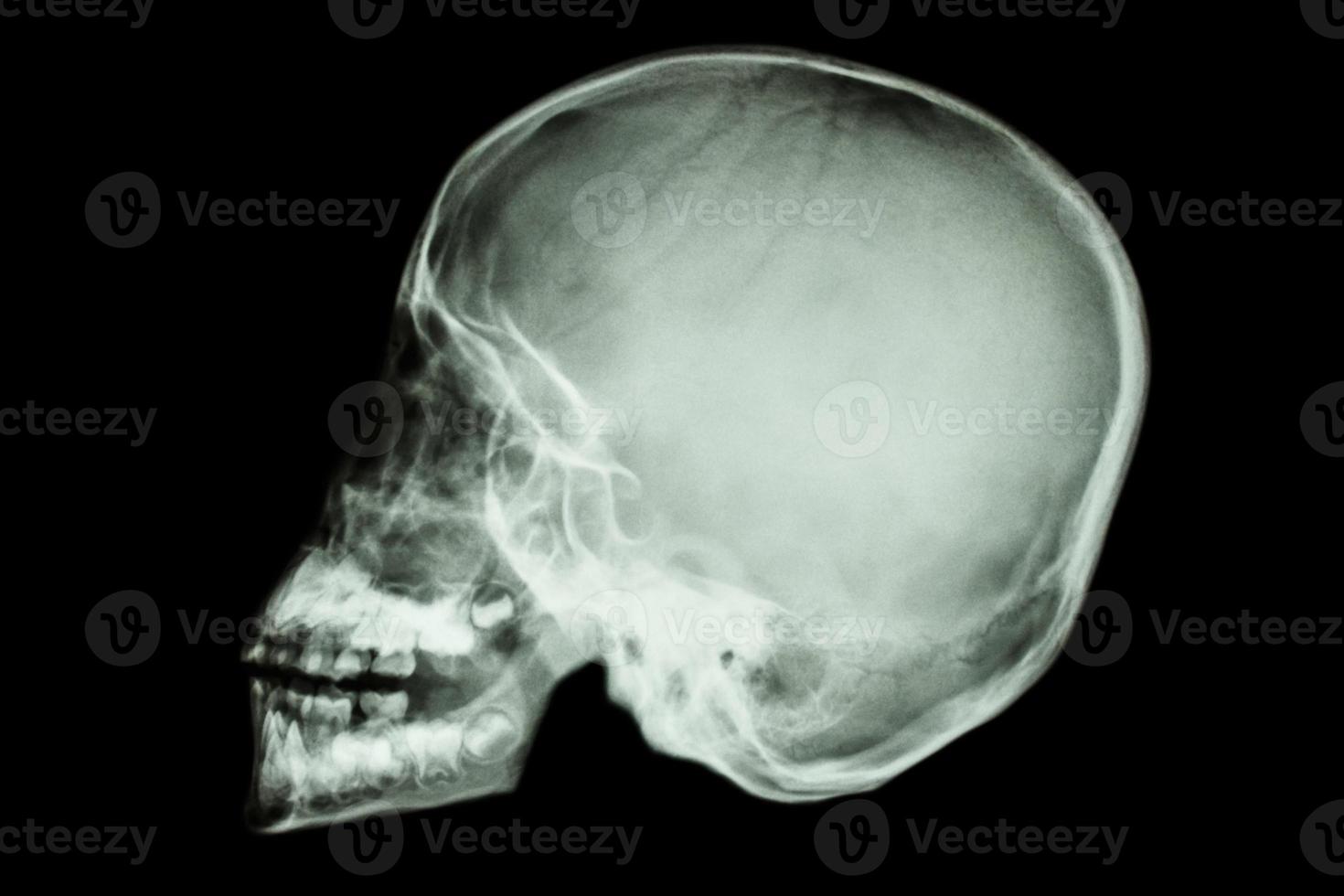 film x-ray asian child skull  Thai people photo