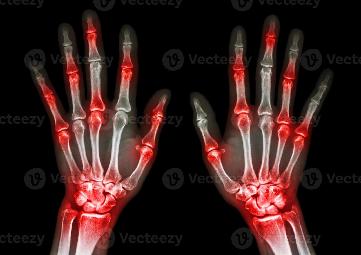 film x-ray both human's hands and arthritis at multiple joint  Gout , Rheumatoid photo