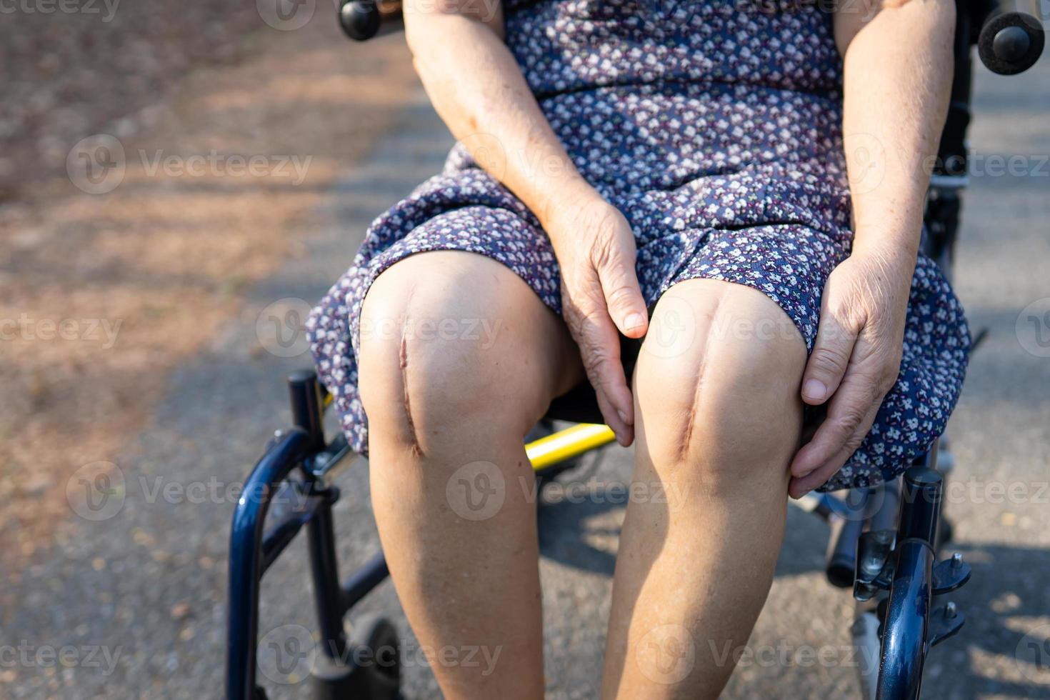 Asian senior or elderly old lady woman patient show her scars surgical total knee joint replacement Suture wound surgery arthroplasty on bed in nursing hospital ward  healthy strong medical concept. photo