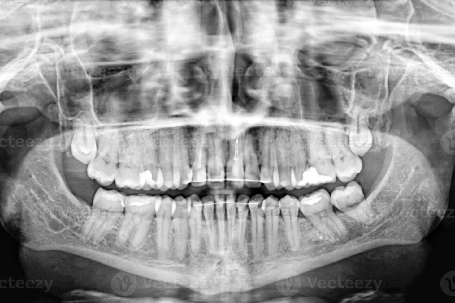 Exploración panorámica de rayos X de los dientes humanos. Examen y tratamiento. banner de cuidado dental. foto