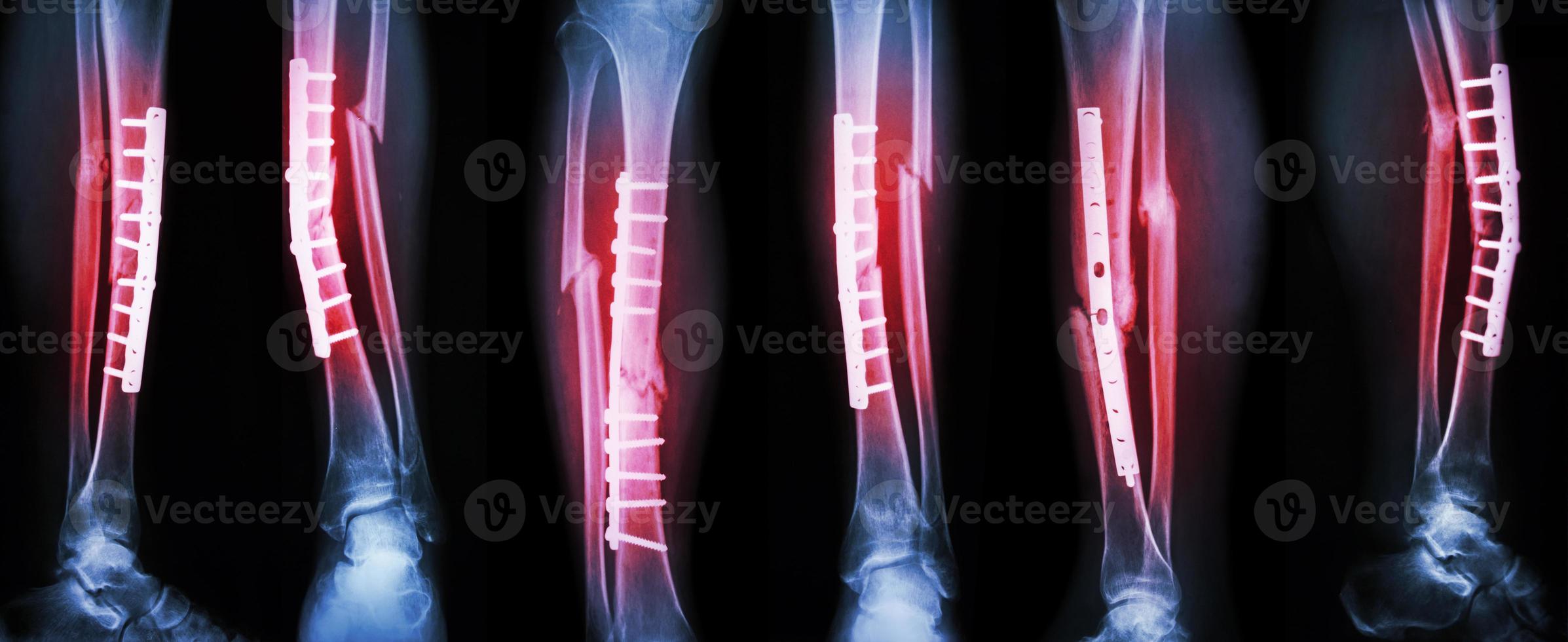 Collection image of leg fracture and surgical treatment by internal fixation with plate and screw . Break tibia and fibula bone . photo