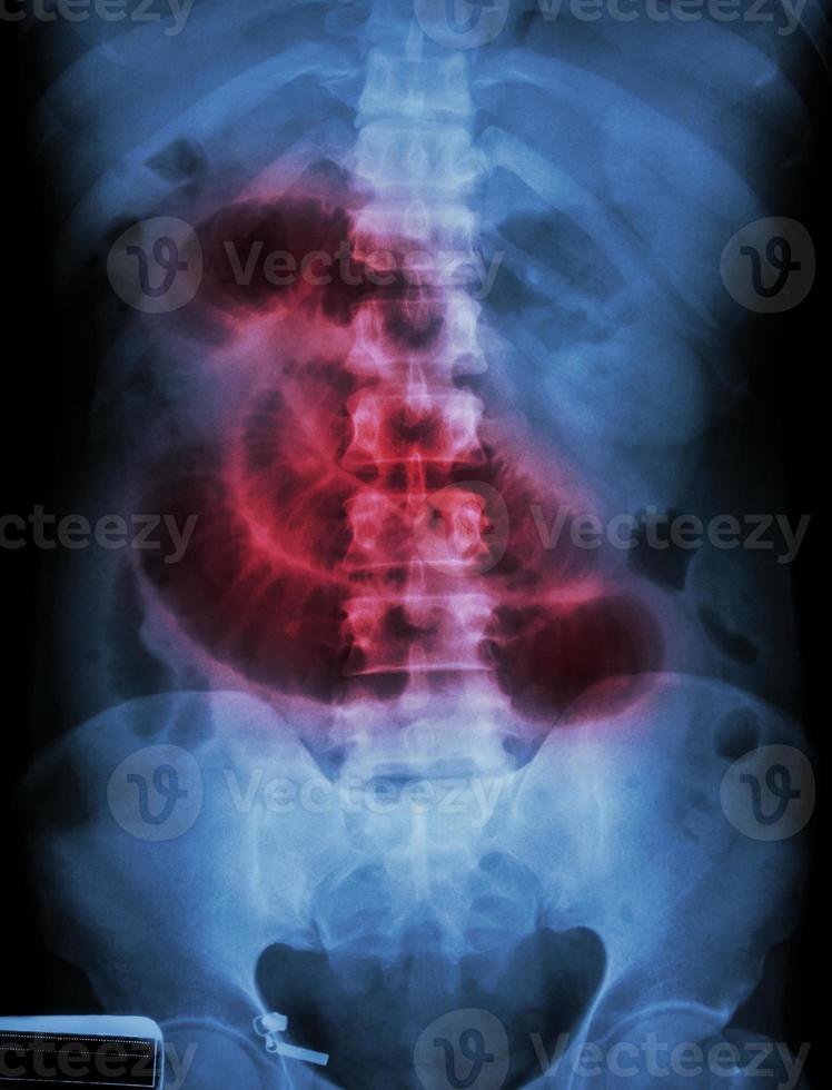 Small intestine obstruction  Film X-ray abdomen supine  Show small intestine dilate photo