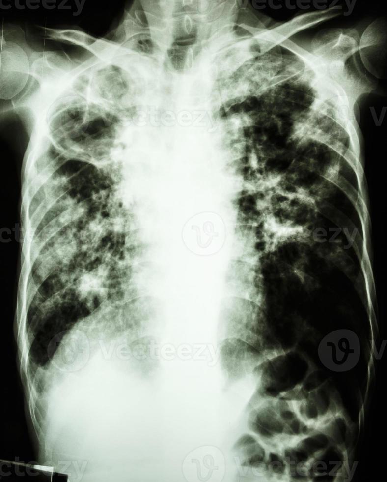 Film chest x-ray show cavity at right lung,fibrosis and interstitial and patchy infiltrate at both lung due to Mycobacterium tuberculosis infection  Pulmonary Tuberculosis photo