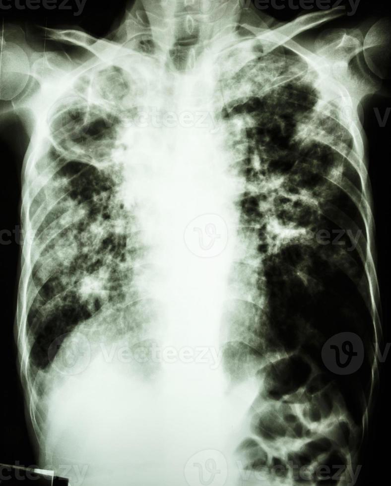 Película radiografía de tórax que muestra cavidad en el pulmón derecho, fibrosis e infiltrado intersticial y en parches en ambos pulmones debido a infección por Mycobacterium tuberculosis tuberculosis pulmonar foto