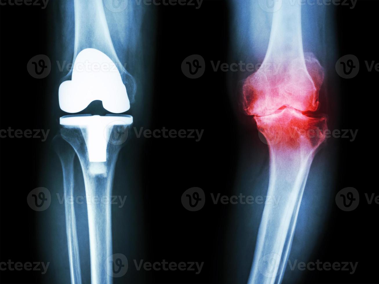 Radiografía de película de rodilla de paciente de rodilla con osteoartritis y articulación artificial foto