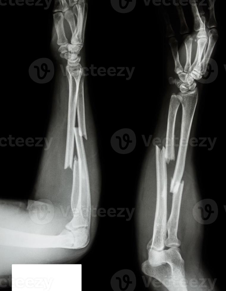 Fracture shaft of radius and ulnar bone photo