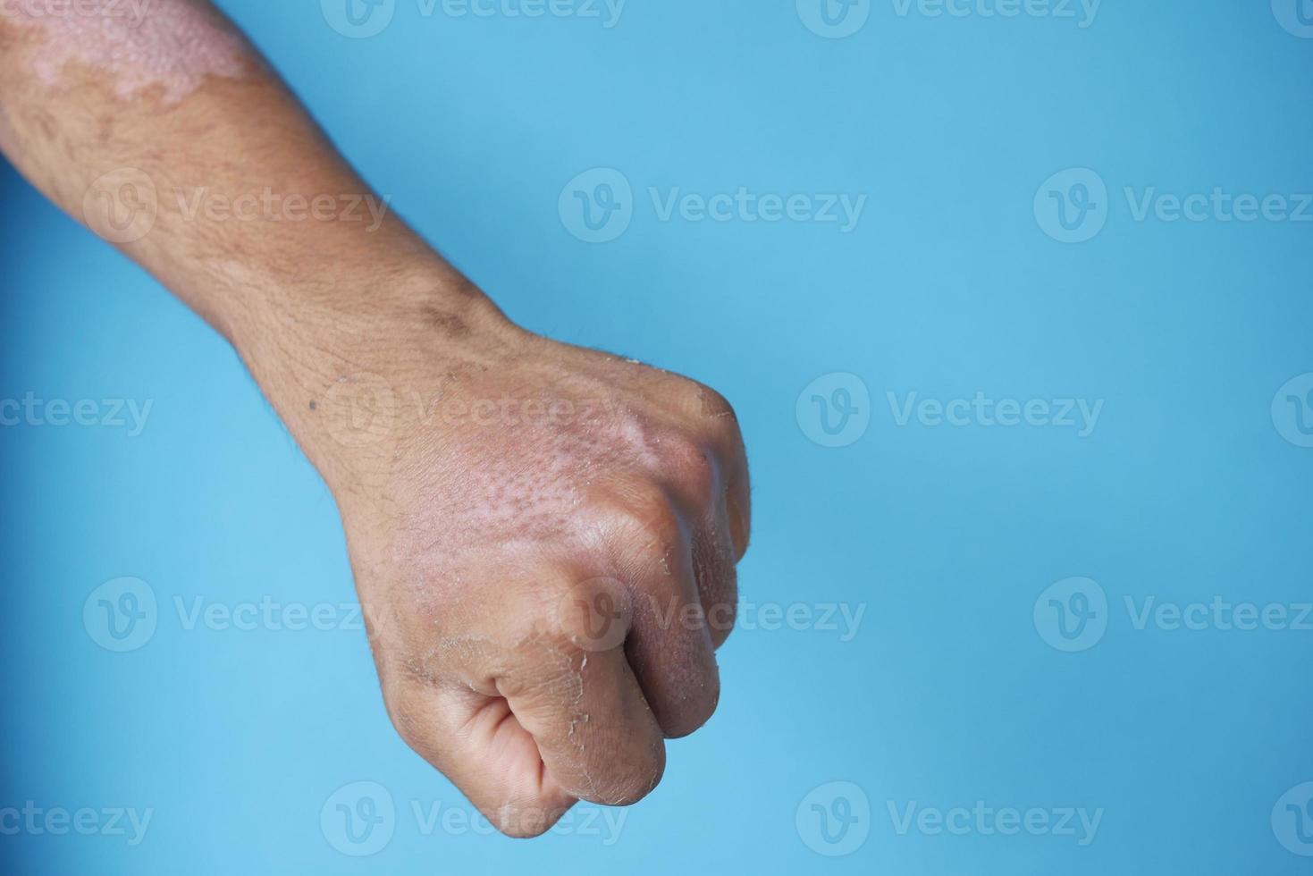 Burns on man's hand on blue background photo