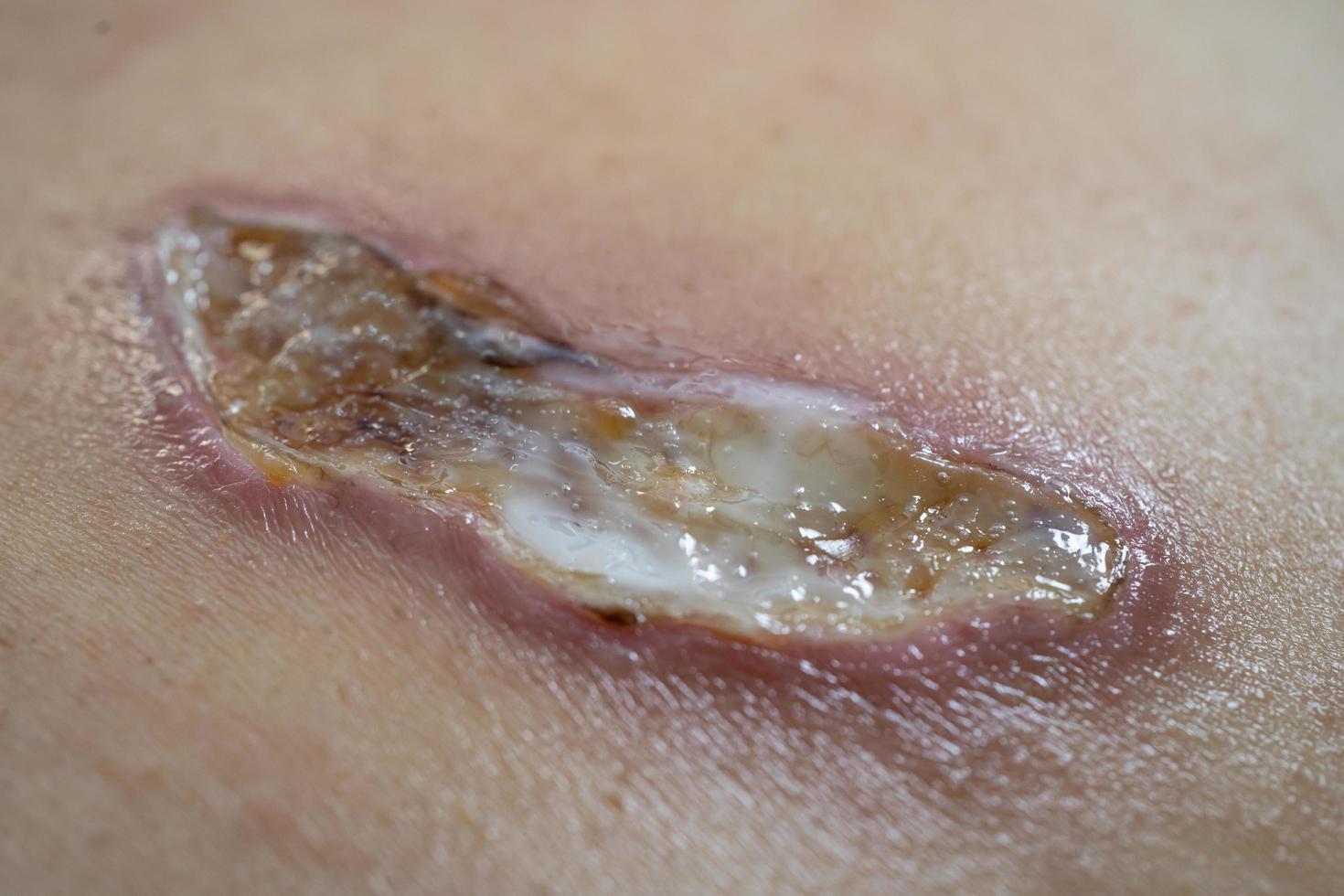 Burn and scald wound on belly plastic hot water bag attached to paralysis woman patient without feeling. photo