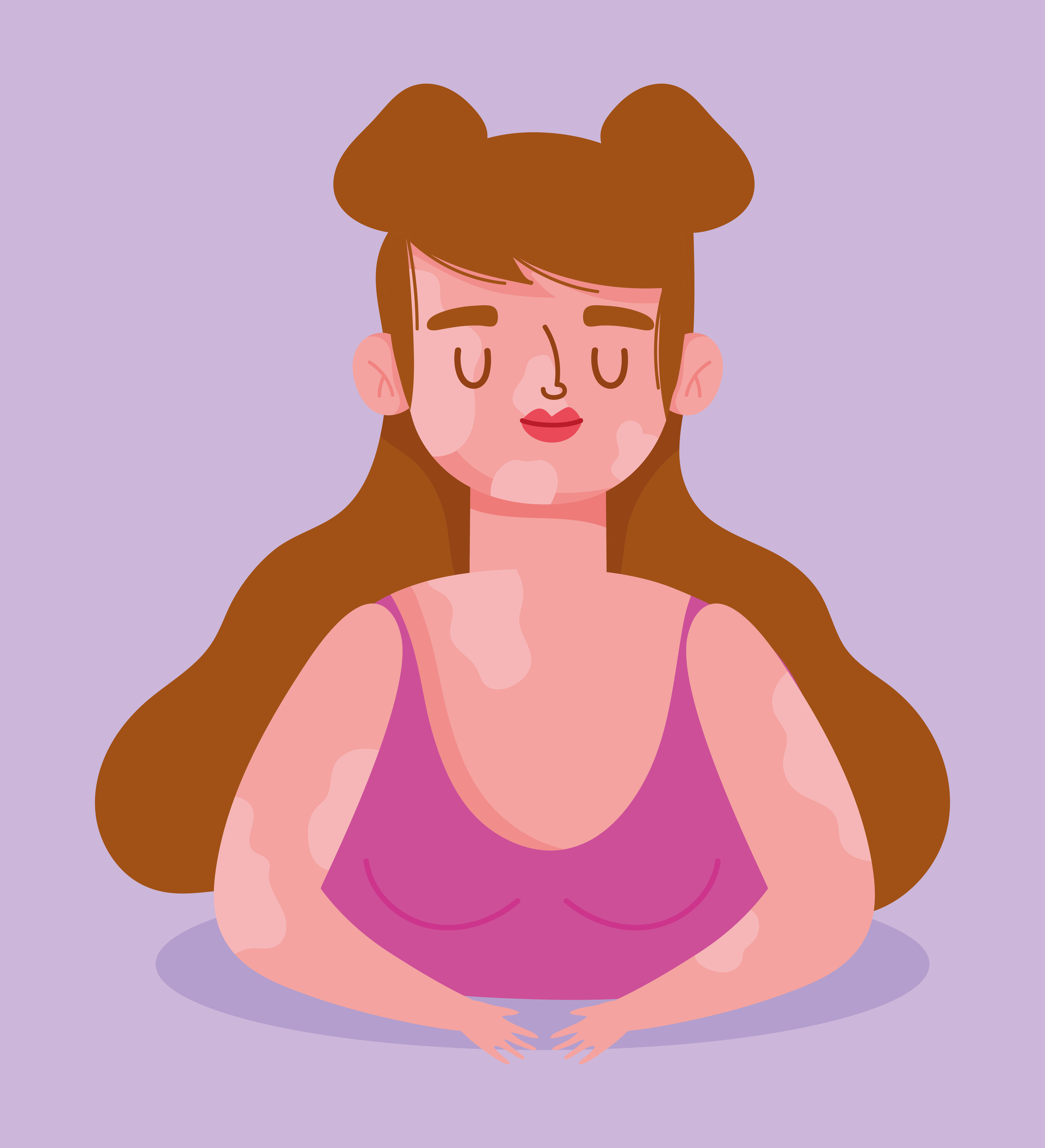 perfectly imperfect, cartoon woman with vitiligo 2777467