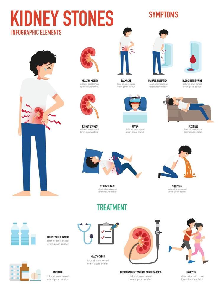 Ilustración de vector de infografía de cálculos renales