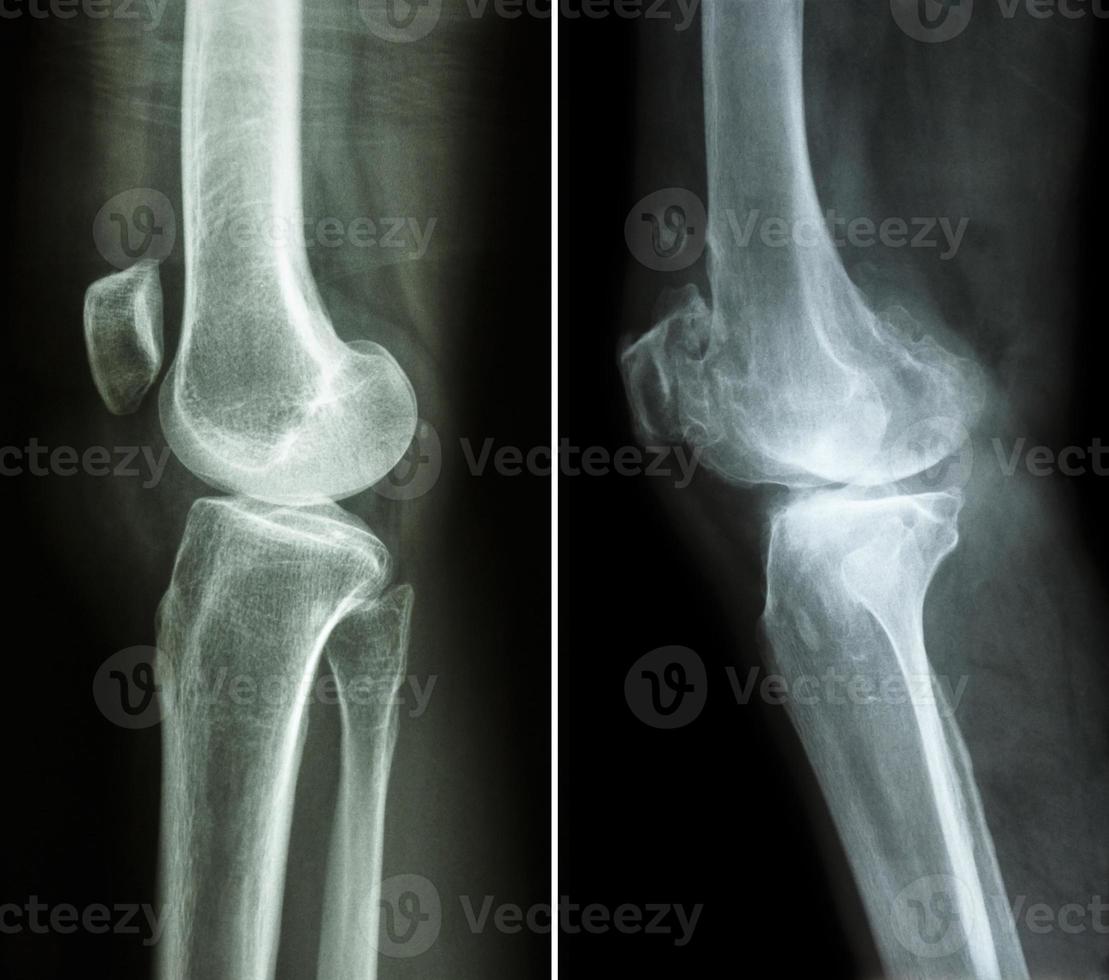 rodilla normal y rodilla con osteoartritis foto