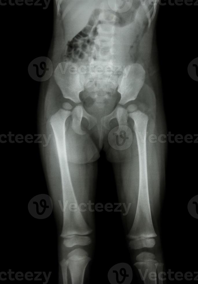 Film x-ray normal body of child photo