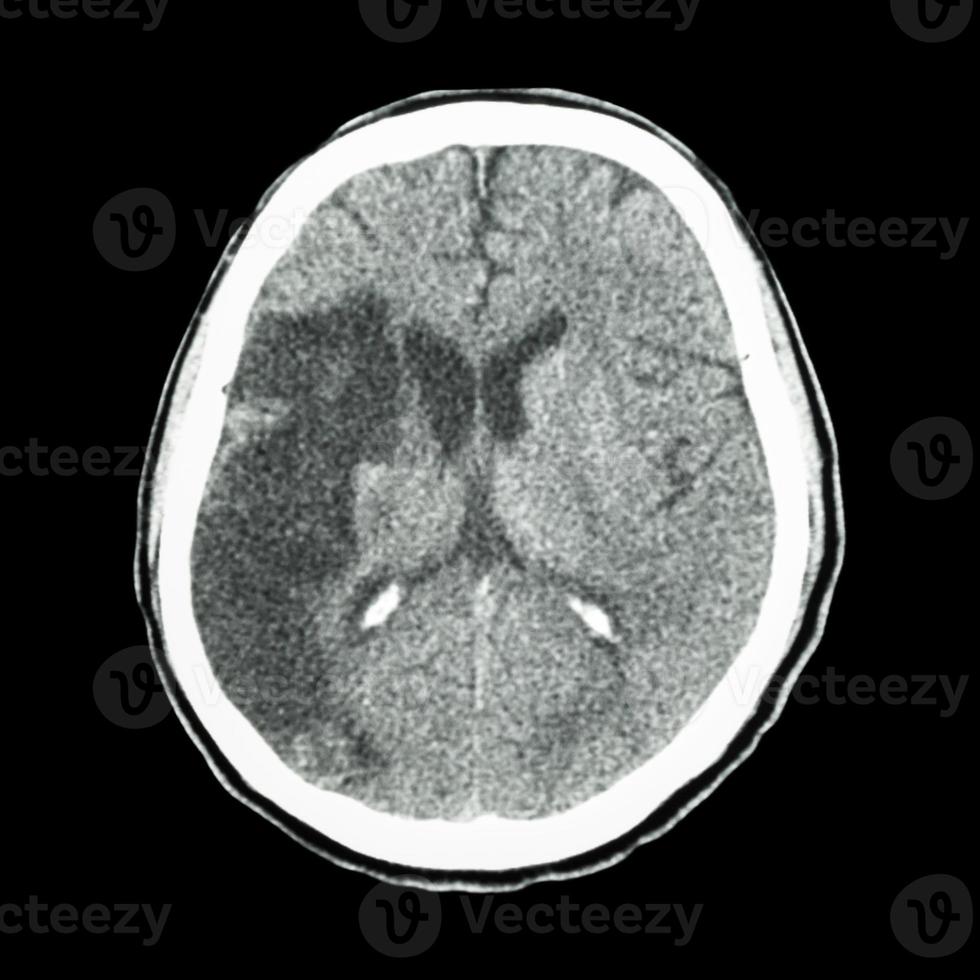 ct cerebro mostrar accidente cerebrovascular isquémico foto