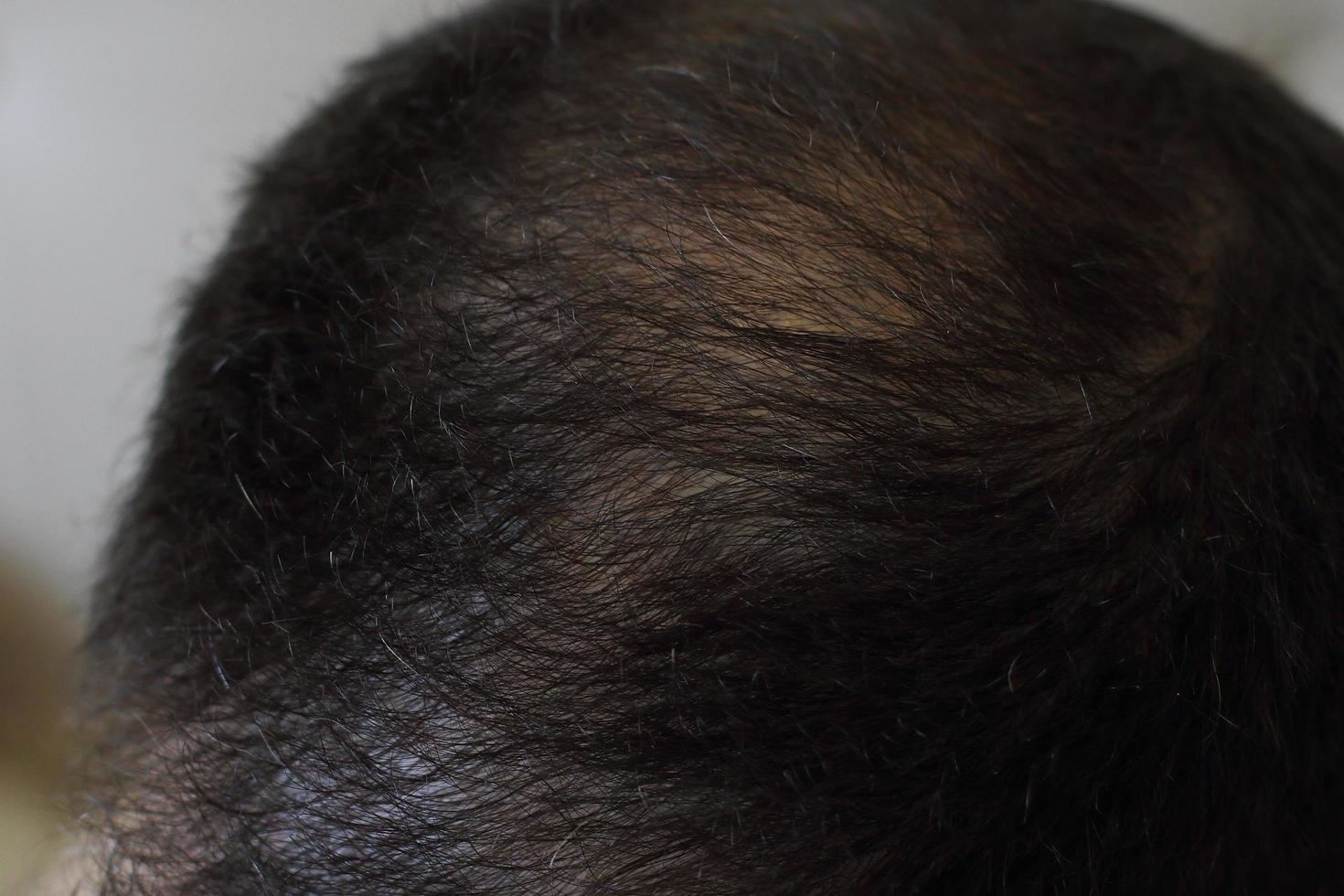 Hair loss, man scalp, baldness closeup photo