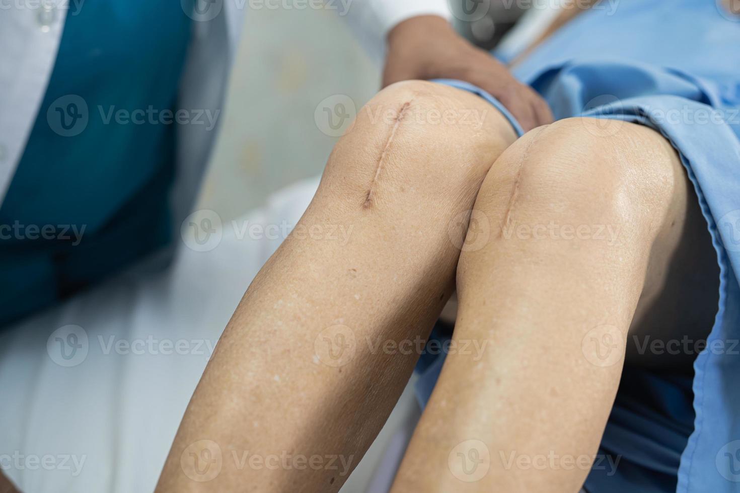 Asian senior or elderly old lady woman patient show her scars surgical total knee joint replacement Suture wound surgery arthroplasty on bed in nursing hospital ward, healthy strong medical concept. photo