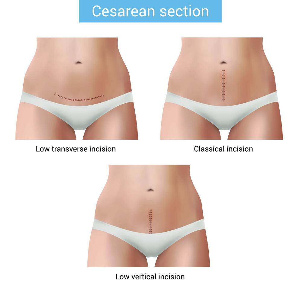 Cesarean Section Stitches Composition Vector Illustration
