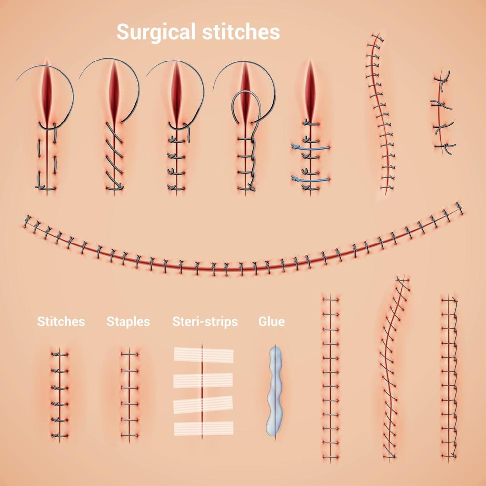 Surgical Stitches Infographic Set Vector Illustration