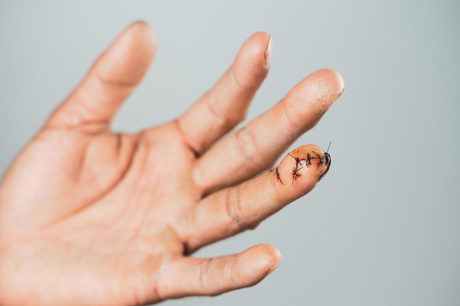 Cerca de la mano del hombre con la herida suturada en el dedo. heridos, salud y concepto médico. foto