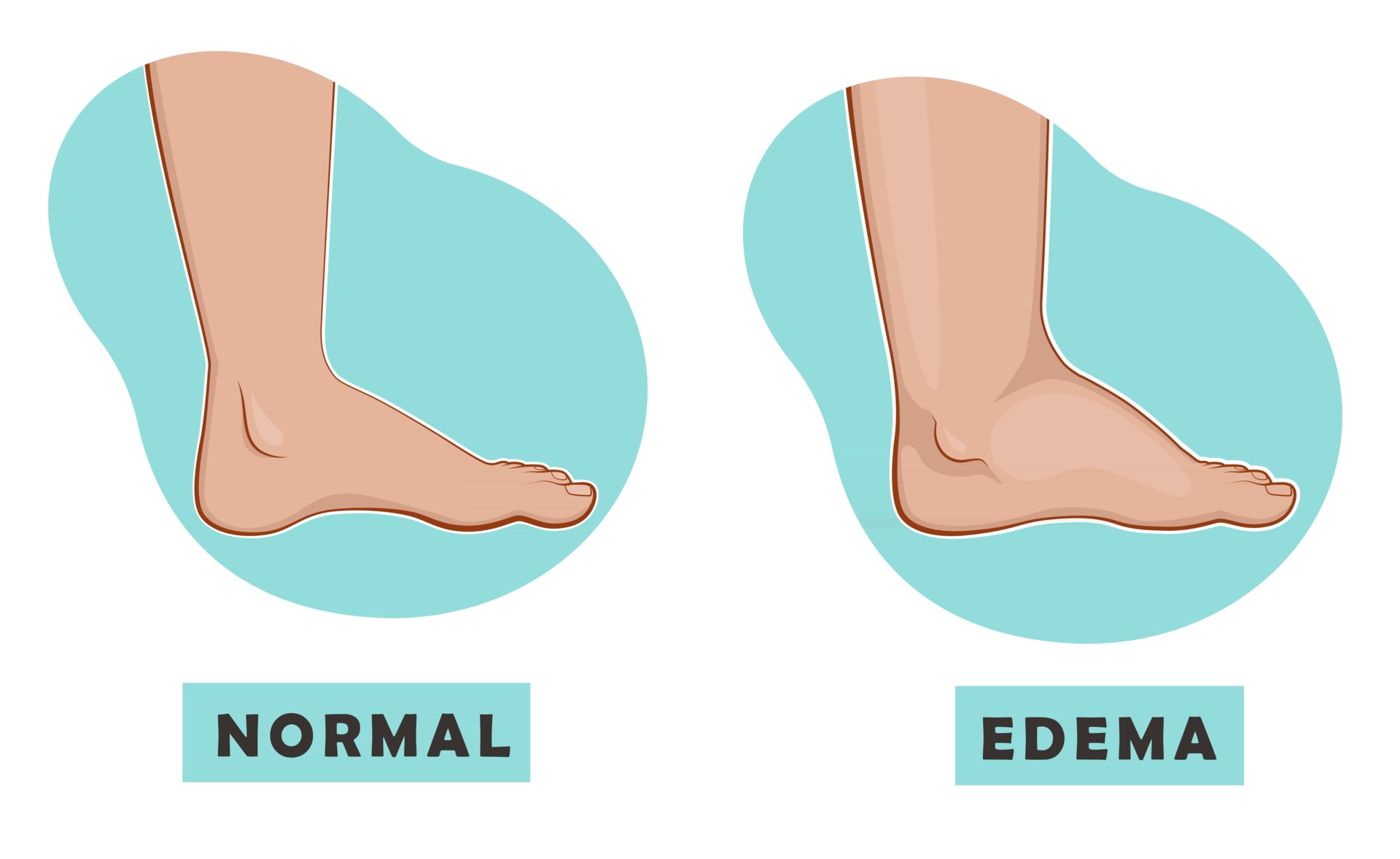 A swollen foot and ankle and a normal foot. Vector illustration of the