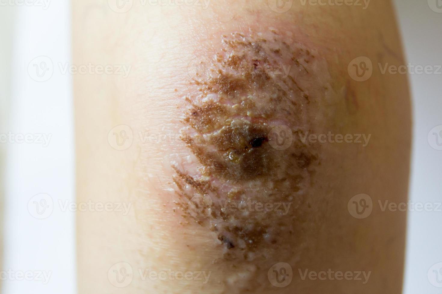 Closed up of red scab injury on woman knee background photo