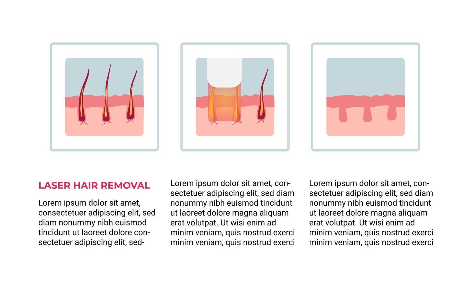 Laser hair removal concept vector