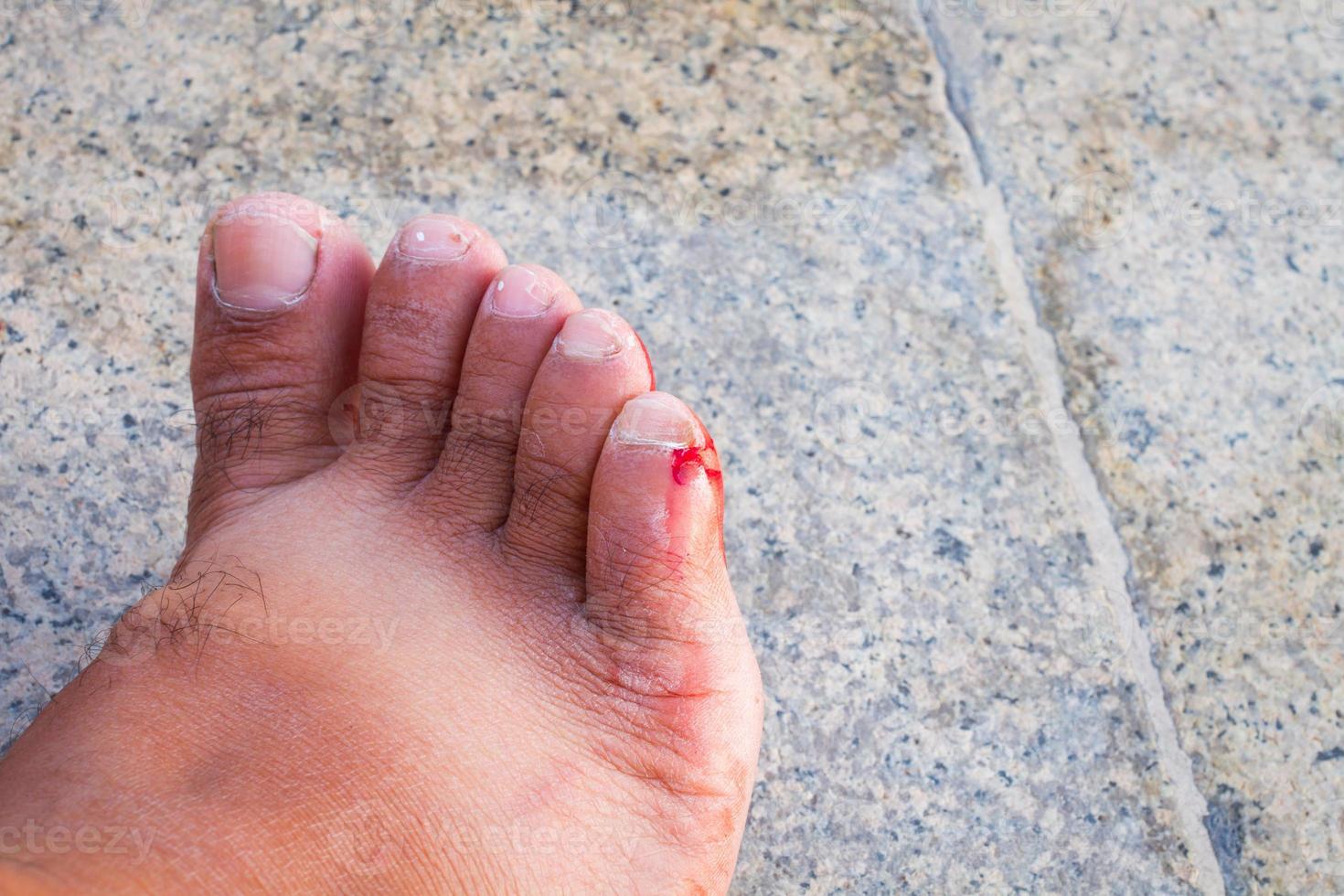 Incised bloody wound on the foot of a man photo