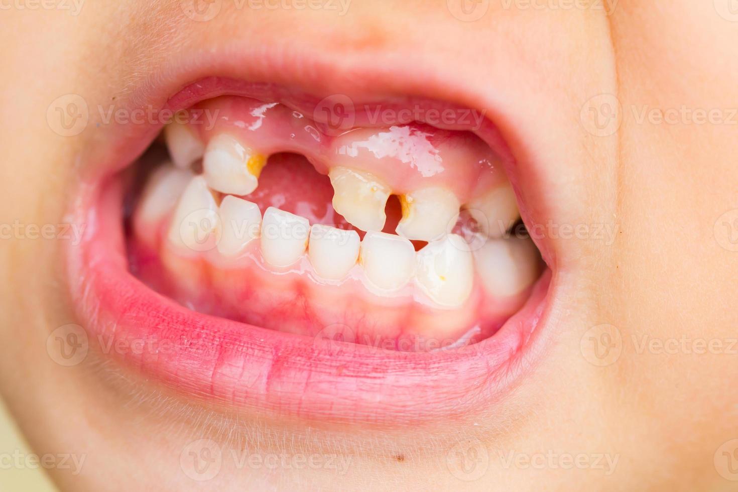 selective focus broken teeth of asian little girl photo