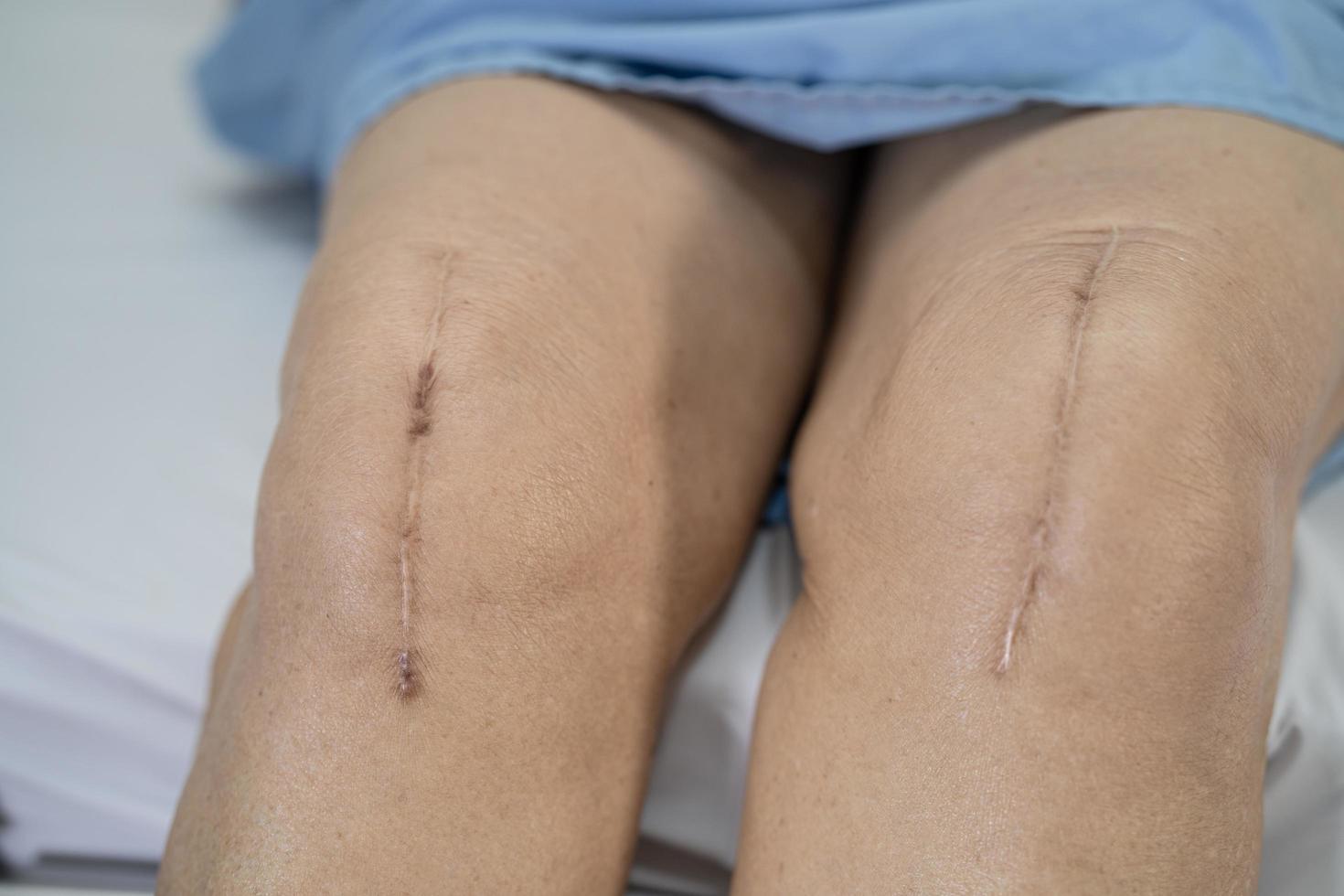 Asian senior or elderly old lady woman patient show her scars surgical total knee joint replacement Suture wound surgery arthroplasty on bed in nursing hospital ward, healthy strong medical concept. photo