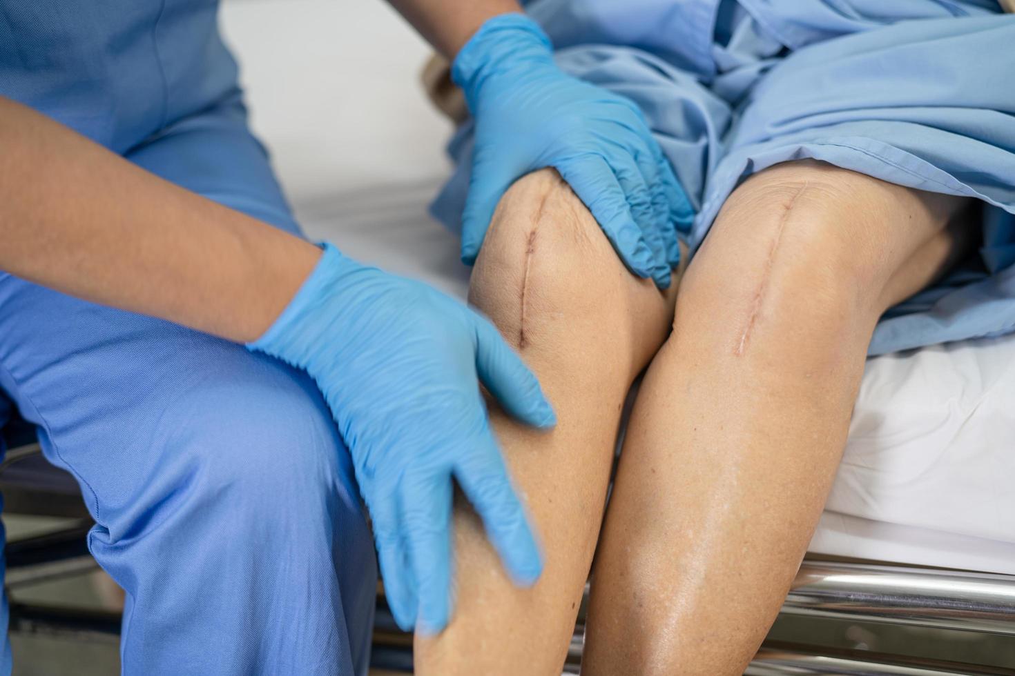 Asian senior or elderly old lady woman patient show her scars surgical total knee joint replacement Suture wound surgery arthroplasty on bed in nursing hospital ward, healthy strong medical concept. photo