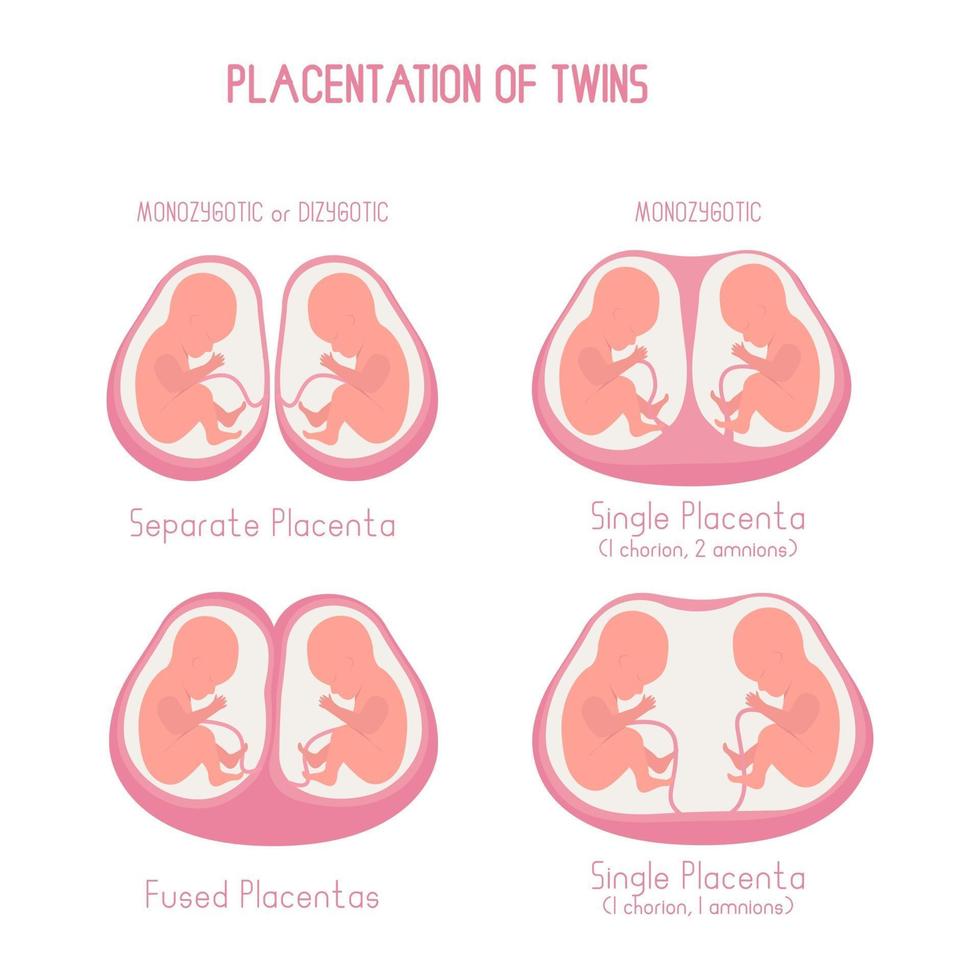 Placentation of twins flat illustration vector