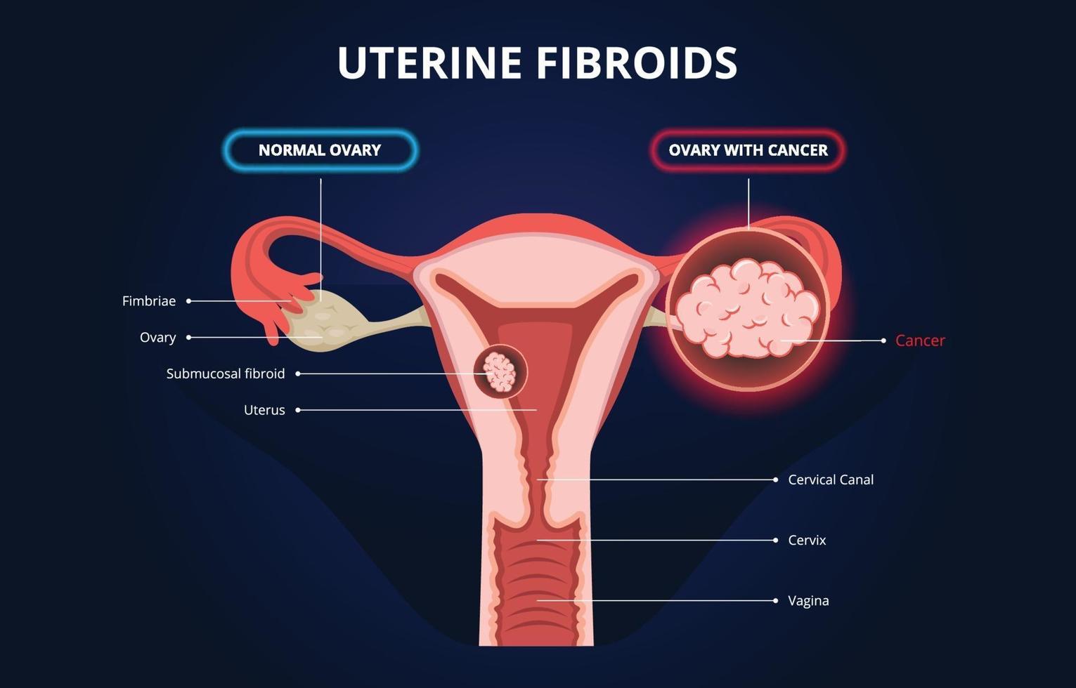 Ovarian Cancer Infographics or Uterine Fibroids vector