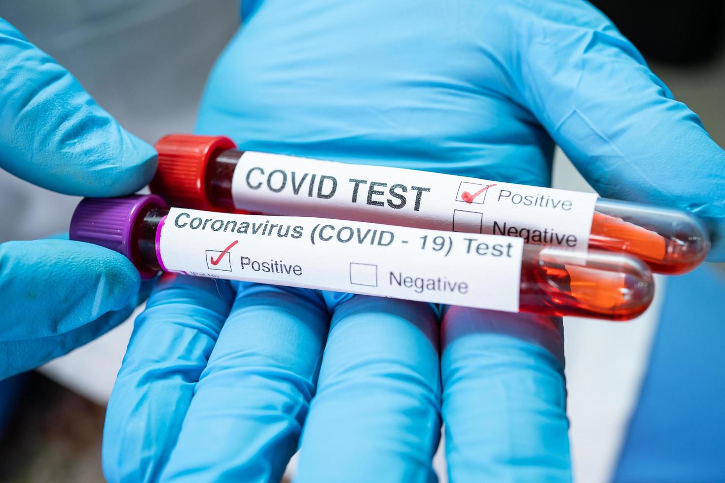 muestra de infección de sangre positiva en tubo de ensayo para coronavirus covid-19 foto