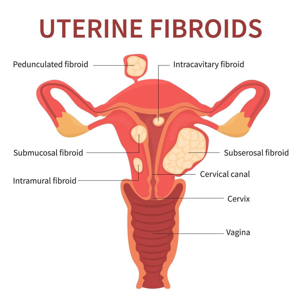 Vista cercana de los fibromas uterinos vector