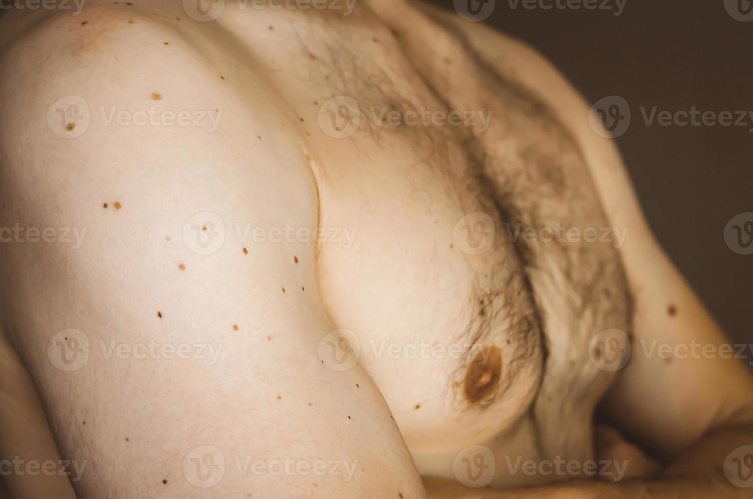 Moles on the chest of a man. photo