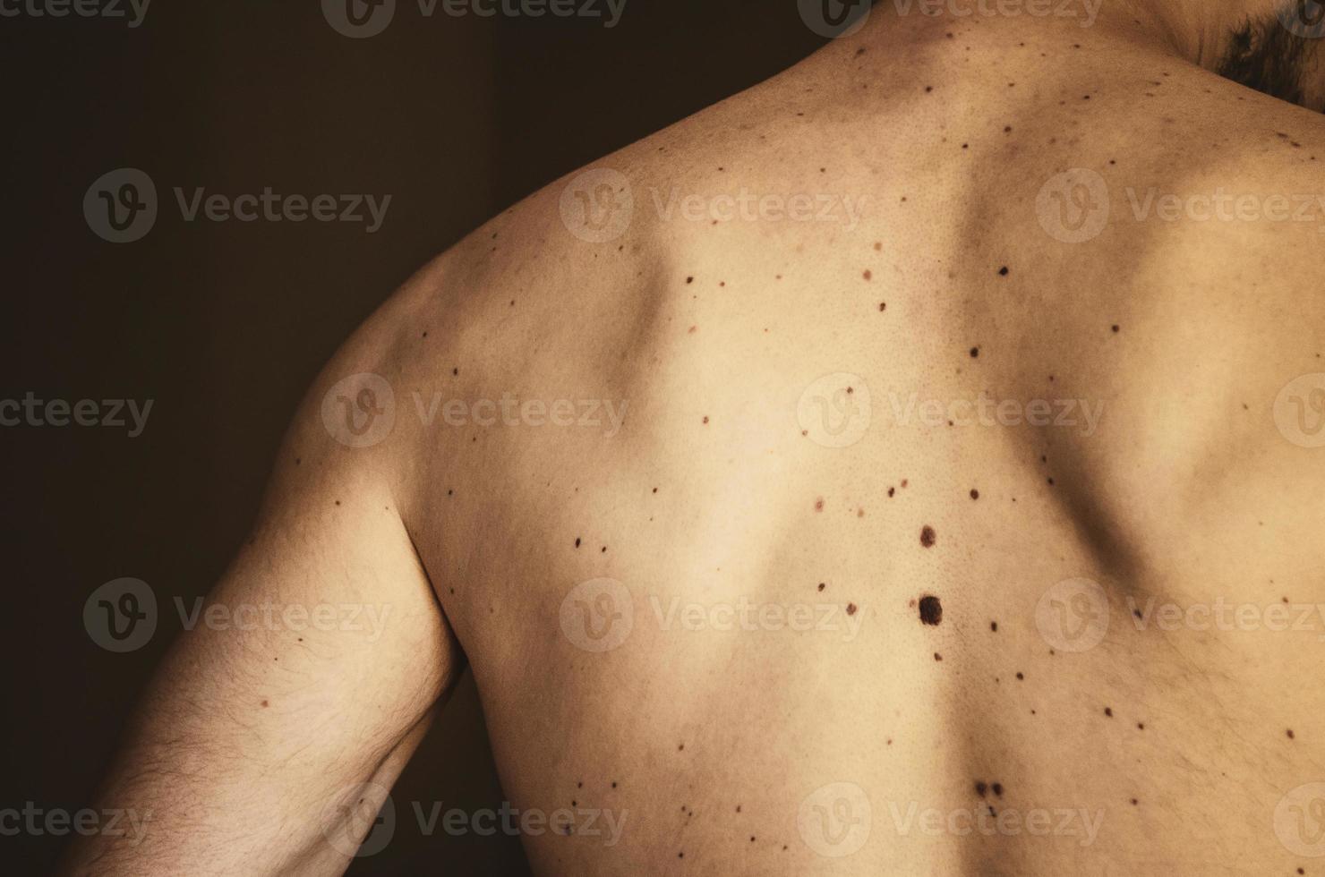 Moles on the back of a man. photo