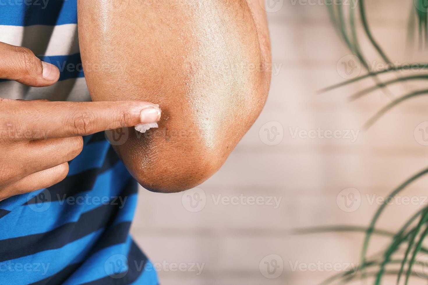 man hand applying petroleum jelly onto skin photo