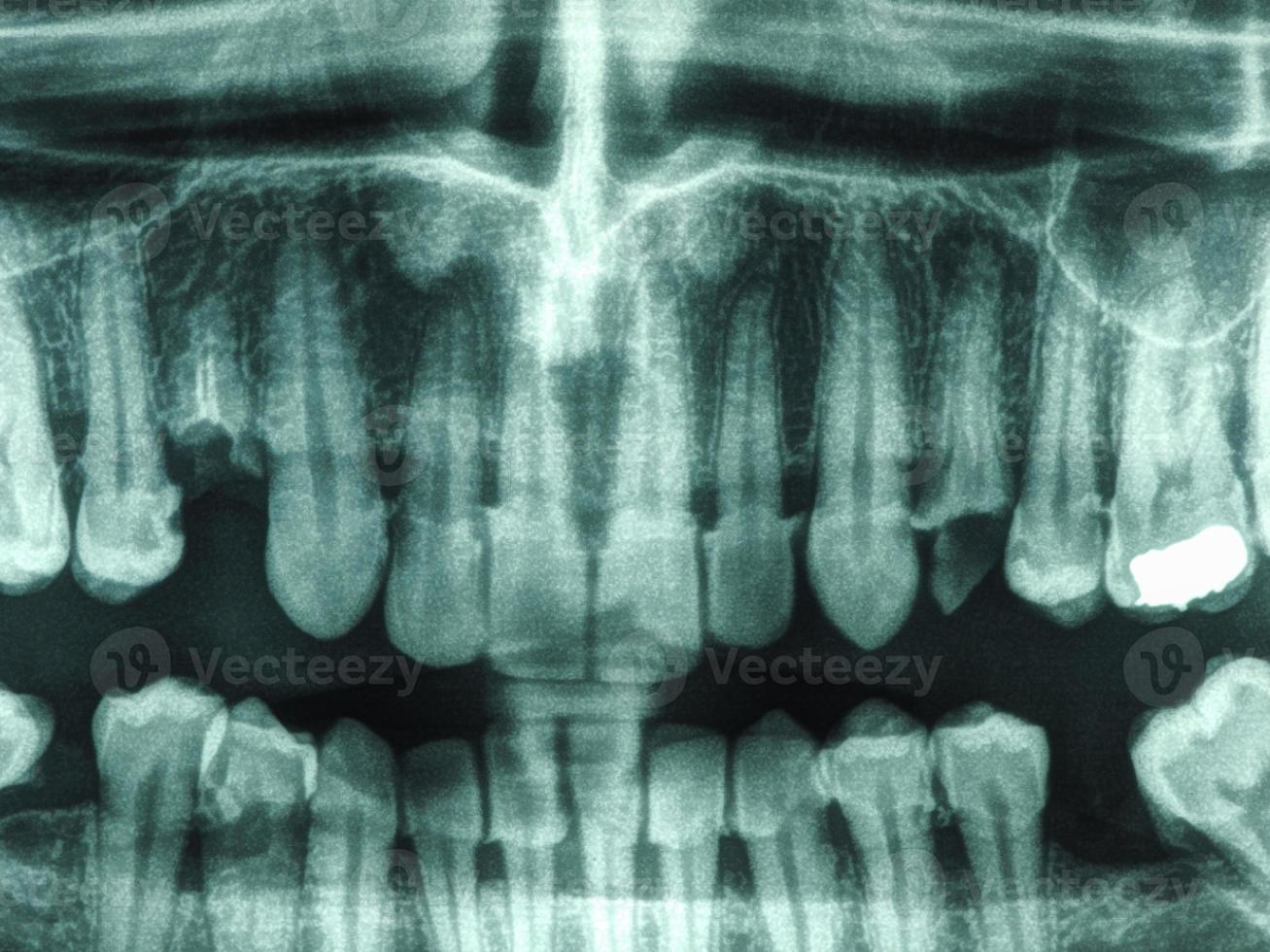 Human teeth xray photo