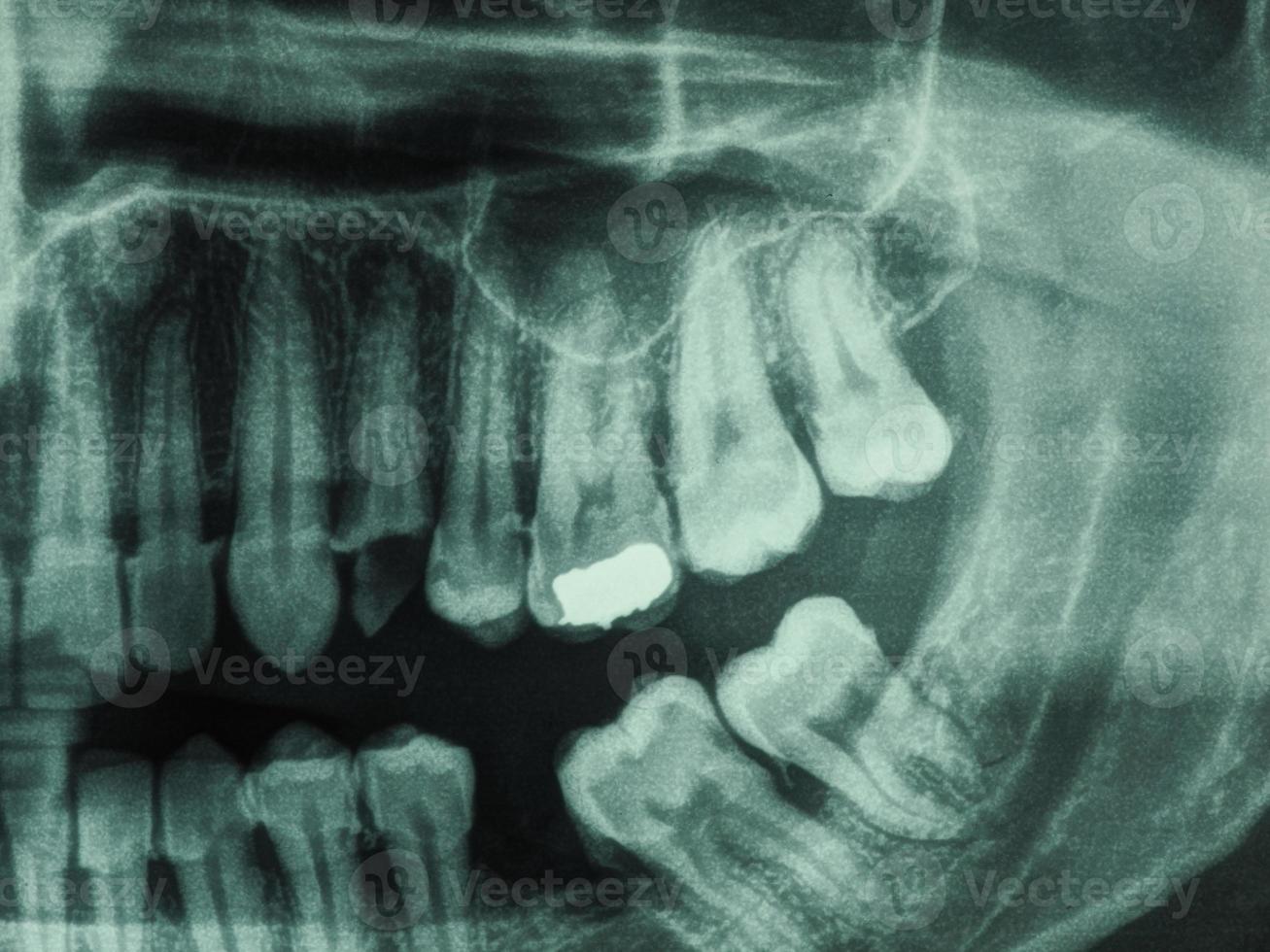 Human teeth xray photo