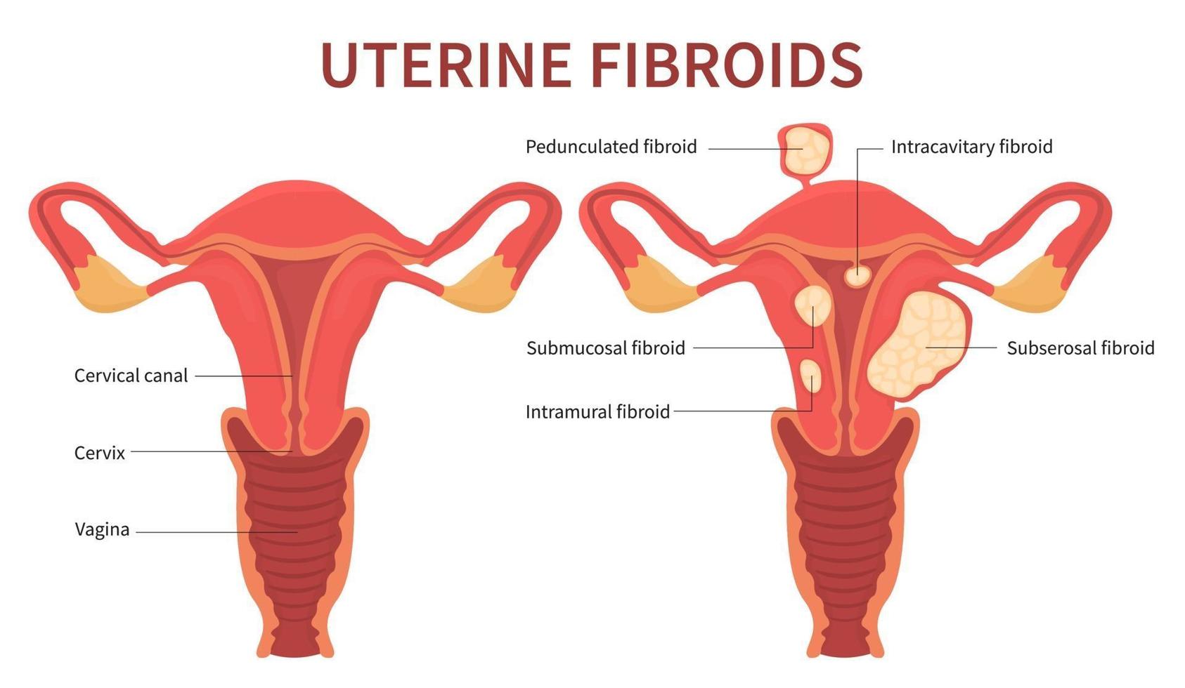 Woman uterine fibroids diagram on white background vector