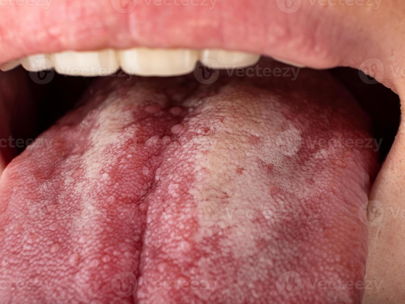 Tongue with stomatitis close up, oral cancer photo