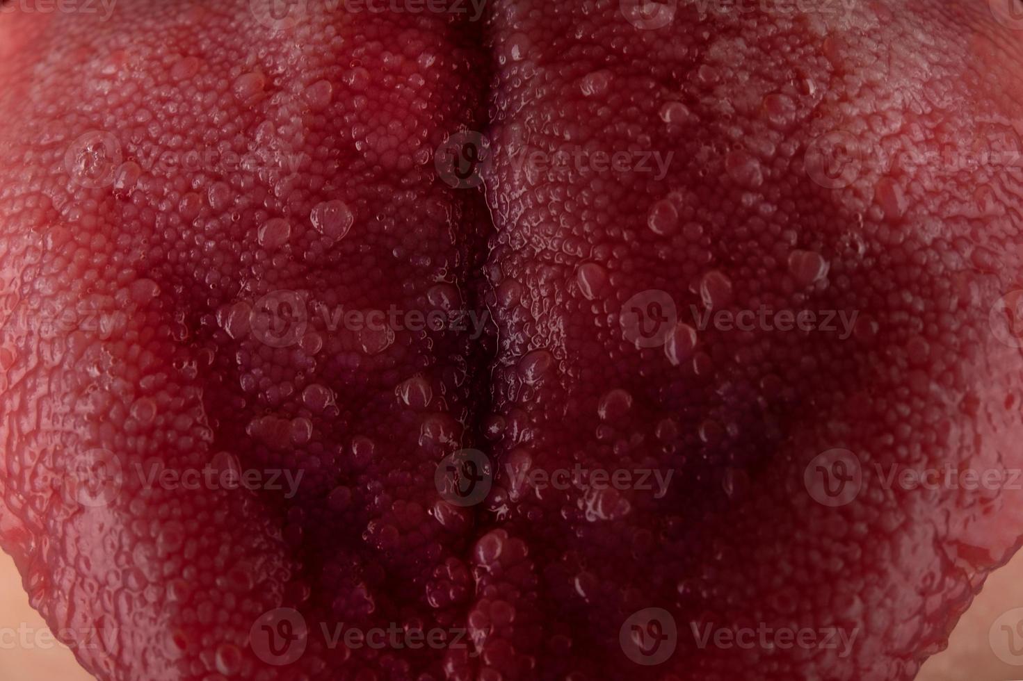 Tongue with stomatitis close up, oral cancer photo