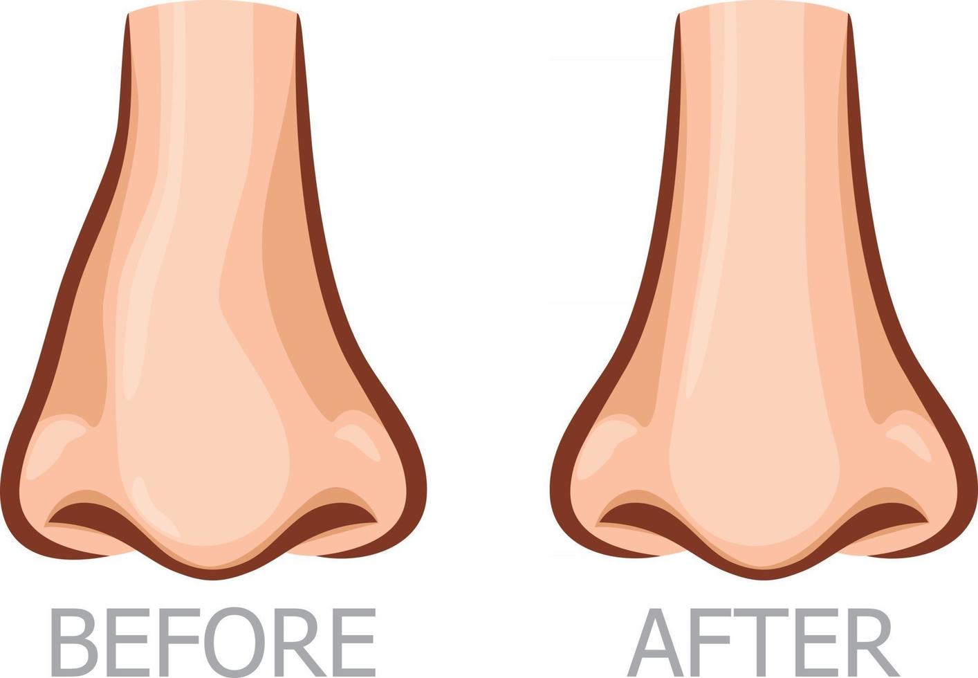 desviación de la nariz antes y después vector