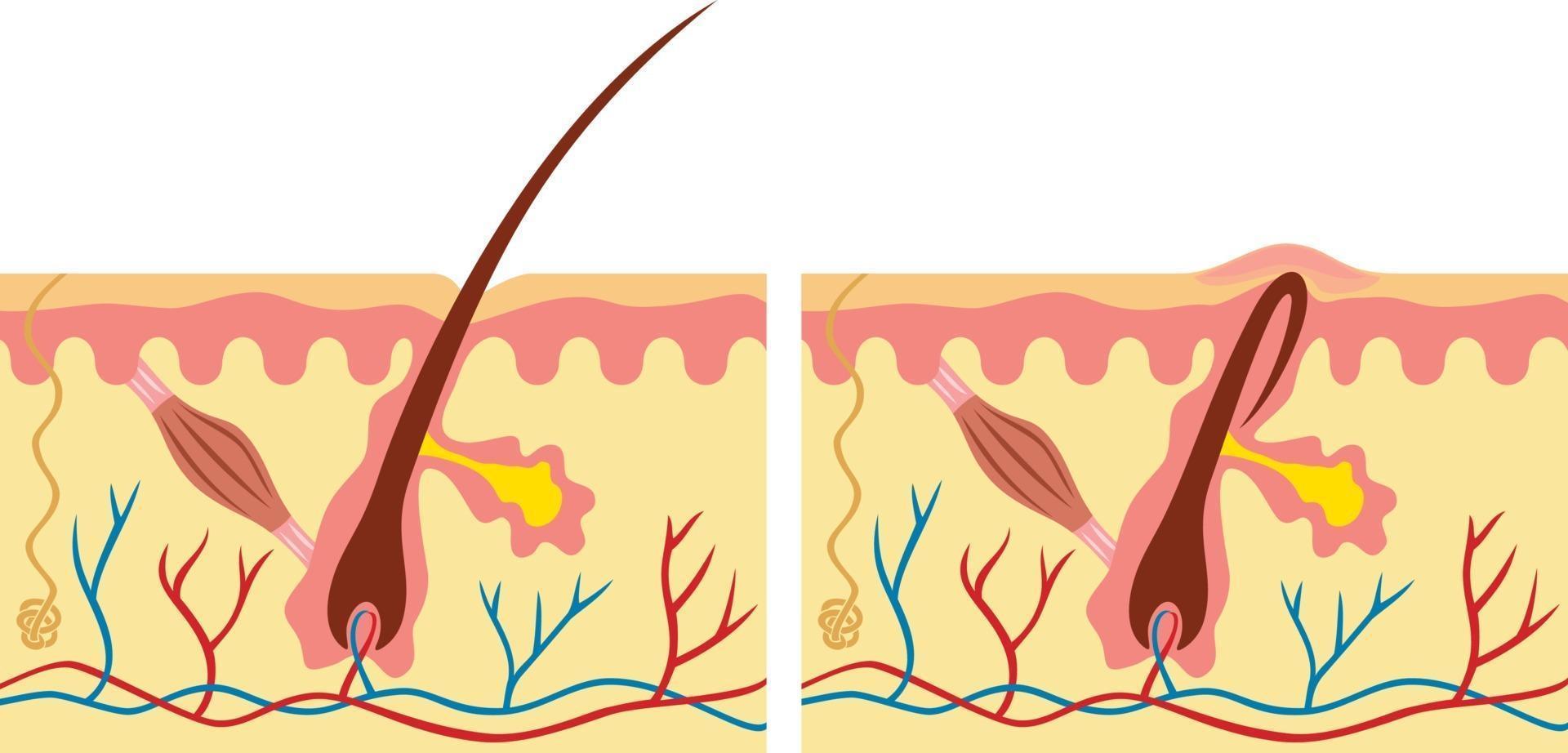 Ingrown and Normal Hair vector