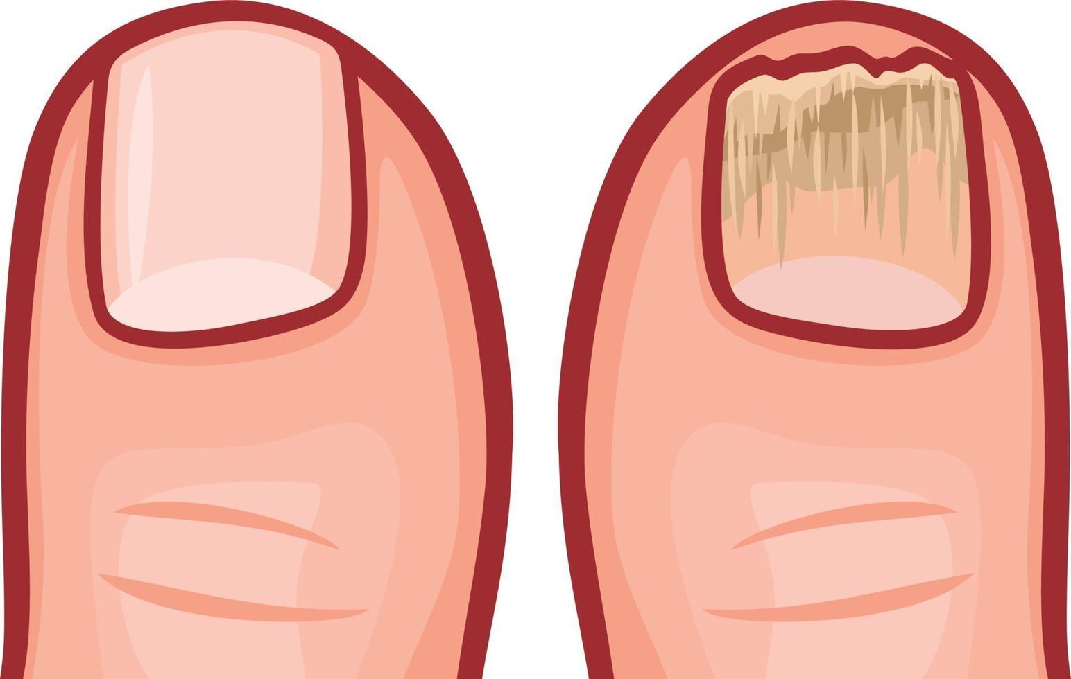 Toe Nail Fungal Infection vector