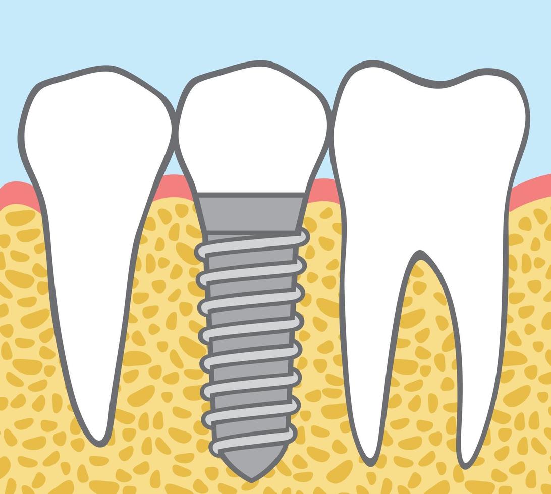 Dental Implant Design vector