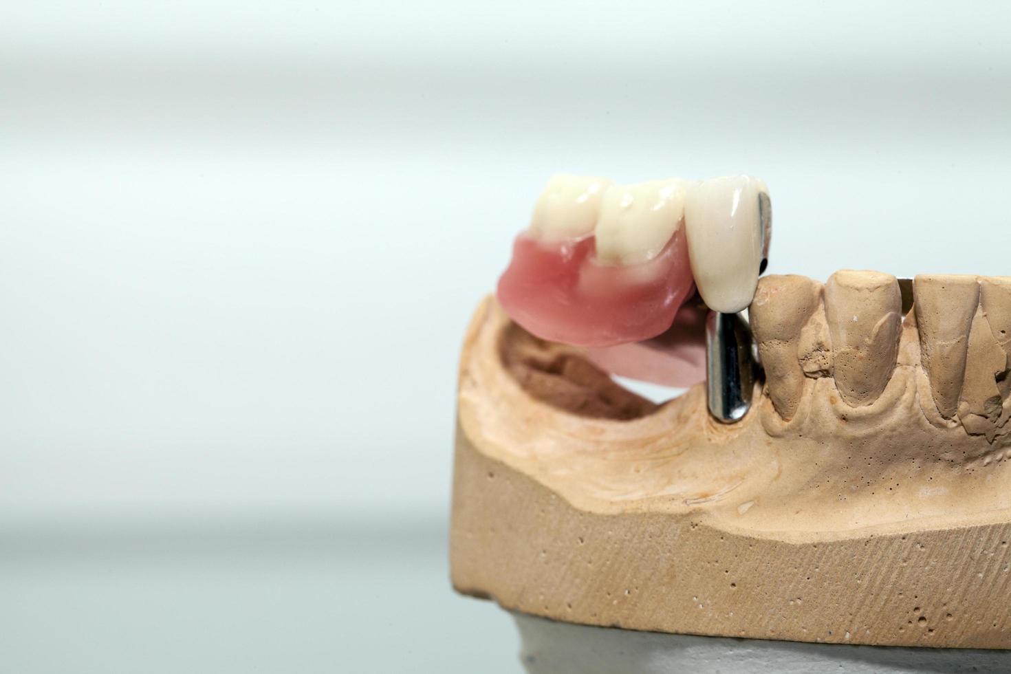 Zirconium Porcelain Tooth plate in Dentist Store photo