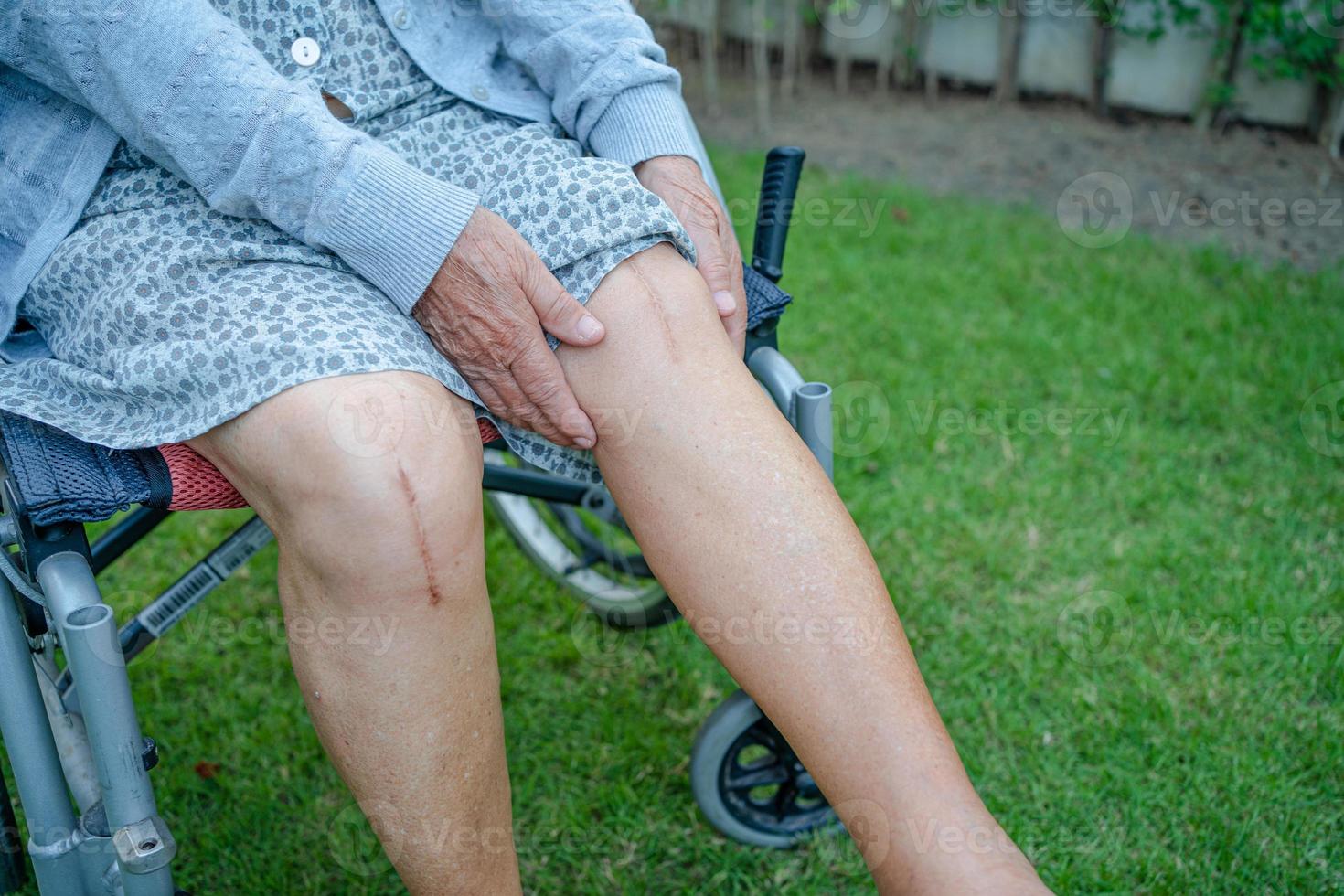 Asian senior woman patient show her scars surgical total knee photo